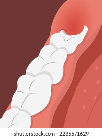 Illustration of teeth row with inflamed gum over the growing wisdom tooth. Flat vector illustration, realistic style