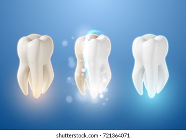 Illustration of Teeth Whitening System. 3D Realistic Vector Tooth Cleaning Process Illustration