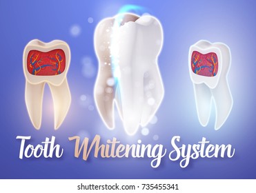 Illustration of Teeth Whitening System. 3D Realistic Vector Tooth Cleaning Process Illustration