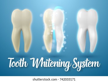 Illustration of Teeth Whitening System. 3D Realistic Vector Tooth Cleaning Process Illustration