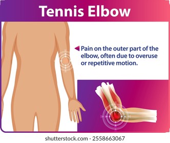 Illustration of tennis elbow pain and anatomy