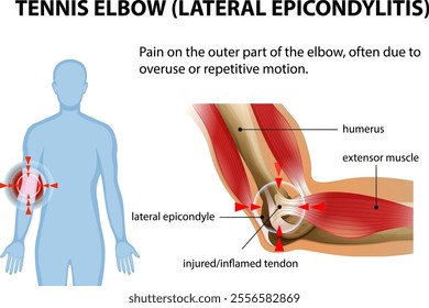 Illustration of tennis elbow symptoms and affected areas