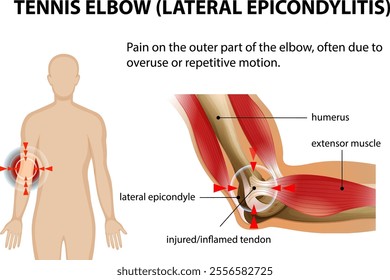 Illustration of tennis elbow symptoms and anatomy