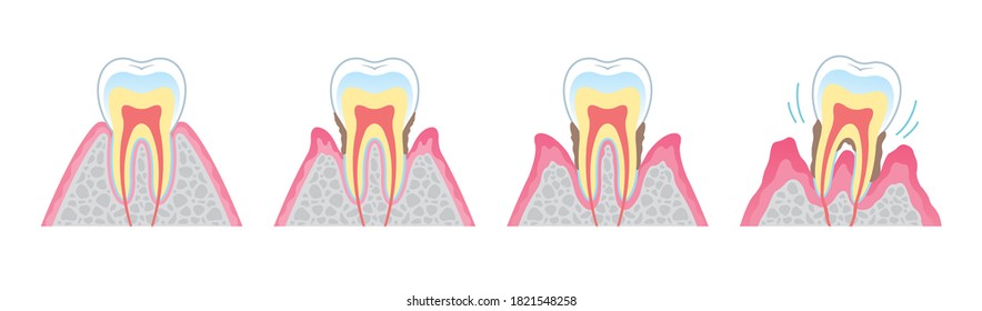 It is an illustration that explains the structure of periodontal disease in cross section and in English. Since it is vector art, it can be edited.