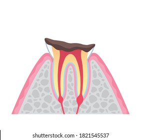 It is an illustration that explains the structure of tooth decay in cross section and English. Since it is vector art, it can be edited.