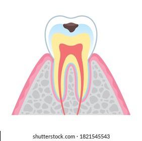 It is an illustration that explains the structure of tooth decay in cross section and English. Since it is vector art, it can be edited.