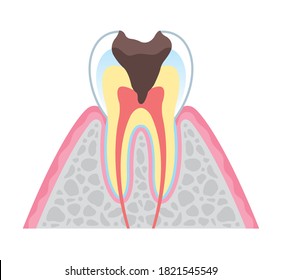 It is an illustration that explains the structure of tooth decay in cross section and English. Since it is vector art, it can be edited.