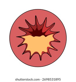 Ilustración de moco espeso en los pulmones, bronquitis, ataque de asma, dificultad para respirar. Inflamación de los bronquios. Ilustración vectorial para médicos, salud y clínicas.