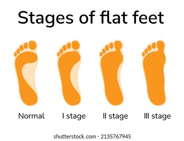 Ilustración de tres etapas de pies planos. Cuatro pisadas representadas - posición normal y etapas de deformidad 
