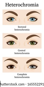 Illustration of three types of heterochromia - partial, central and complete