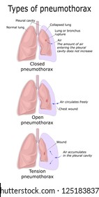 1,068 Pneumothorax Images, Stock Photos & Vectors | Shutterstock