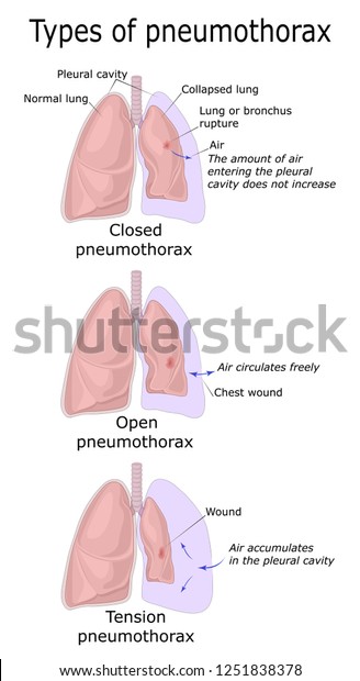 Illustration Three Types Pneumothorax Closed Open Stock Vector Royalty Free 1251838378