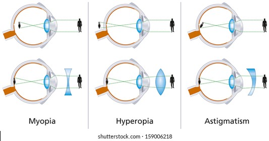 szembetegségek - myopia és hyperopia)