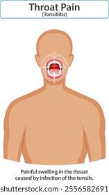 Illustration of throat pain caused by tonsillitis