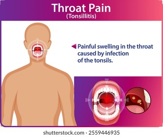 Illustration of throat pain caused by tonsillitis