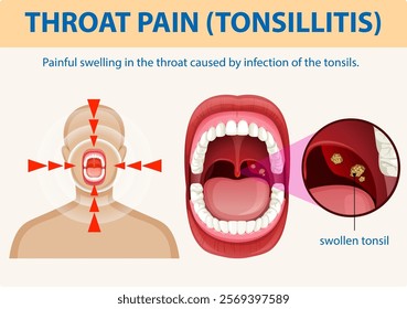 Illustration of throat pain caused by tonsillitis