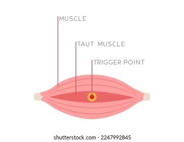 Illustration of tight muscle fibers with trigger point isolated on white background. Concept of injury, muscle pain, Myofascial pain, medical illustration. Flat vector.