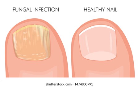Illustration toe nail fungal infection  Used: gradient  transparency  blend mode 