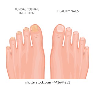 Illustration toe nail fungal infection  Used: gradient  transparency  blend mode 