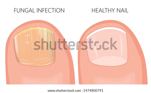 Illustration of toe nail fungal infection. Used:\
gradient, transparency, blend\
mode.
