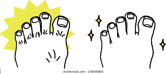 Illustration of the toes of the toes with unnecessary hair removed