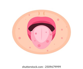 illustration of tongue and cheeks covered with rashes and sores. red spots around the mouth. symptoms of Singapore flu or chicken pox. mouth and skin diseases. health problems. flat style design