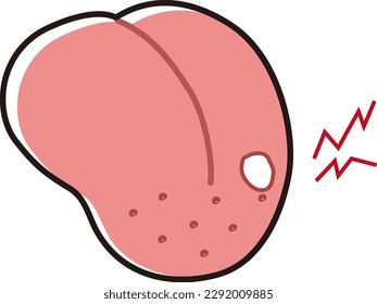 Illustration of a tongue with stomatitis