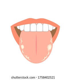 Illustration of tongue symptoms and health