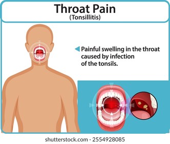 Illustration of tonsillitis symptoms and throat anatomy