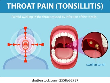 Illustration of tonsillitis symptoms and throat anatomy