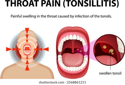 Illustration of tonsillitis symptoms and throat pain