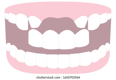 Illustration of a tooth bridging the missing front tooth