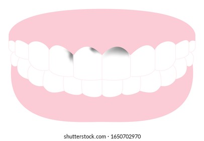 Illustration of tooth with decay advanced to front teeth