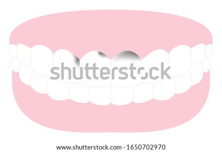 Illustration of tooth with decay advanced to front teeth