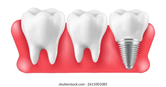 Illustration of tooth implantation, tooth restoration, Mesh gradient wes 
