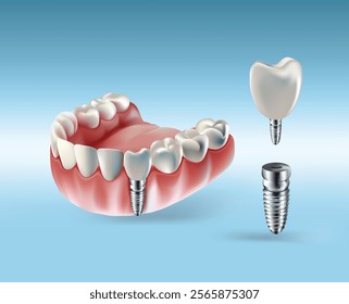 Illustration of tooth implantation, tooth restoration, tooth on a light blue background, Vector illustration