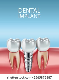 Illustration of tooth implantation, tooth restoration, tooth on a light blue background, Vector illustration