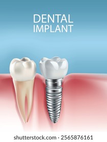 Illustration of tooth implantation, tooth restoration, tooth on a light blue background, Vector illustration