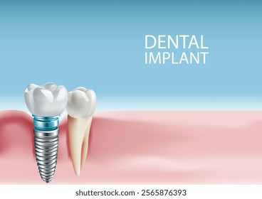 Illustration of tooth implantation, tooth restoration, tooth on a light blue background, Vector illustration
