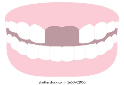 Illustration of tooth missing front teeth in Japan