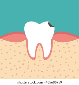 illustration of tooth sectional view decay with caries dental health problem - vector