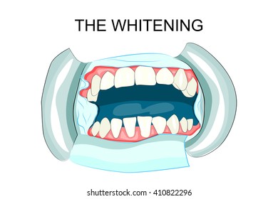 illustration of tooth whitening in dentistry