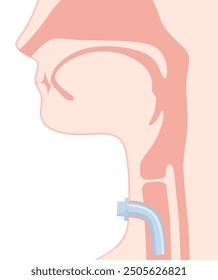 Abbildung einer Trachealkanüle, ungekuffelt, sagittal geschnitten