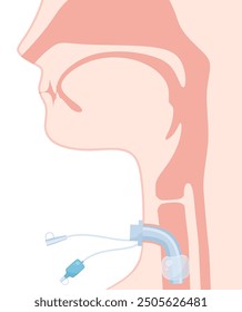 Abbildung einer Trachealkanüle_Manschettenkanüle_Sagittalschnitt