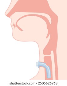 Darstellung eines trachealen Kanülen_Sprechkanülen_sagittal Schnittes