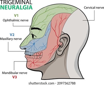 illustration of Trigeminal neuralgia infographic, a chronic pain condition that affects the trigeminal nerve - vector