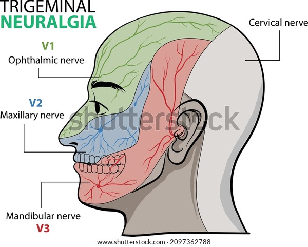 illustration of\
Trigeminal neuralgia infographic, a chronic pain condition that\
affects the trigeminal nerve -\
vector