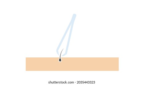 Illustration of tweezers and hair on the skin. Vector isolated editable flat illustration