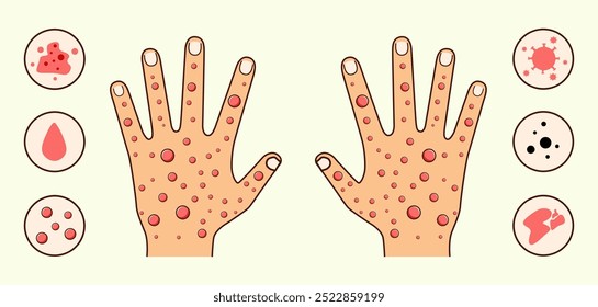 Illustration of Two Hands with Red Spots and There are Explanatory Circles on the Right and Left Sides of the Hands