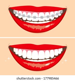 Illustration of two happy smiles showing before and after whitening teeth process